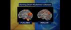 PBS NewsHour | Insulin Spritz Shows Promise for People With Early Signs of Alzheimer's | PBS